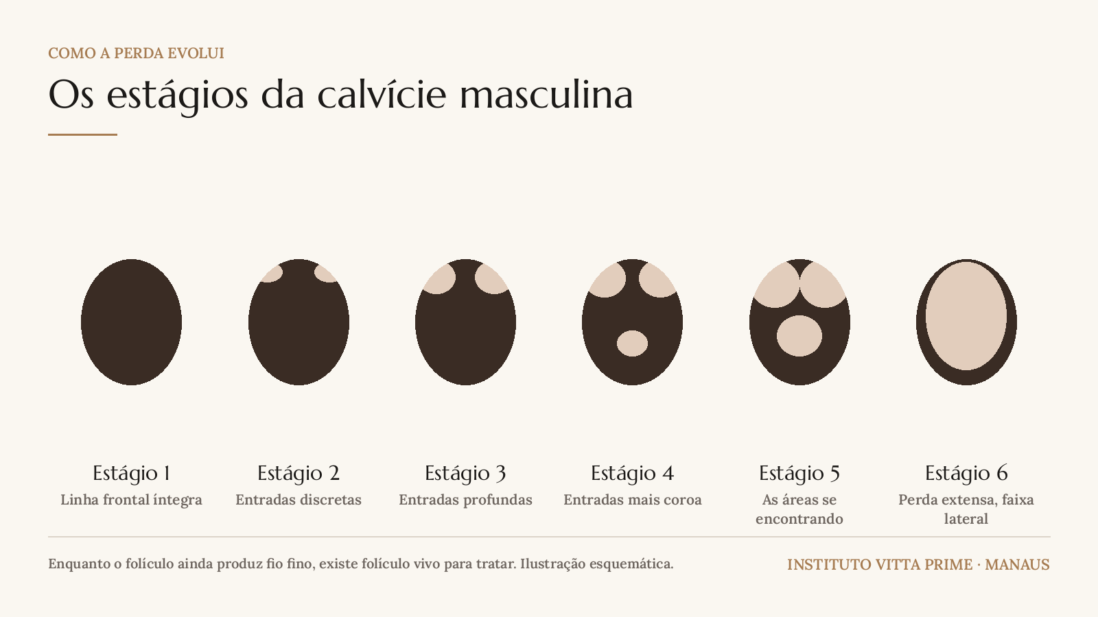 Ilustração dos seis estágios da calvície masculina em vista superior da cabeça, da linha frontal íntegra até a perda extensa com faixa lateral preservada