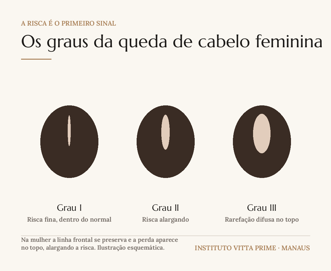 Ilustração dos três graus da queda de cabelo feminina em vista superior da cabeça, mostrando a risca do cabelo alargando progressivamente com a linha frontal preservada